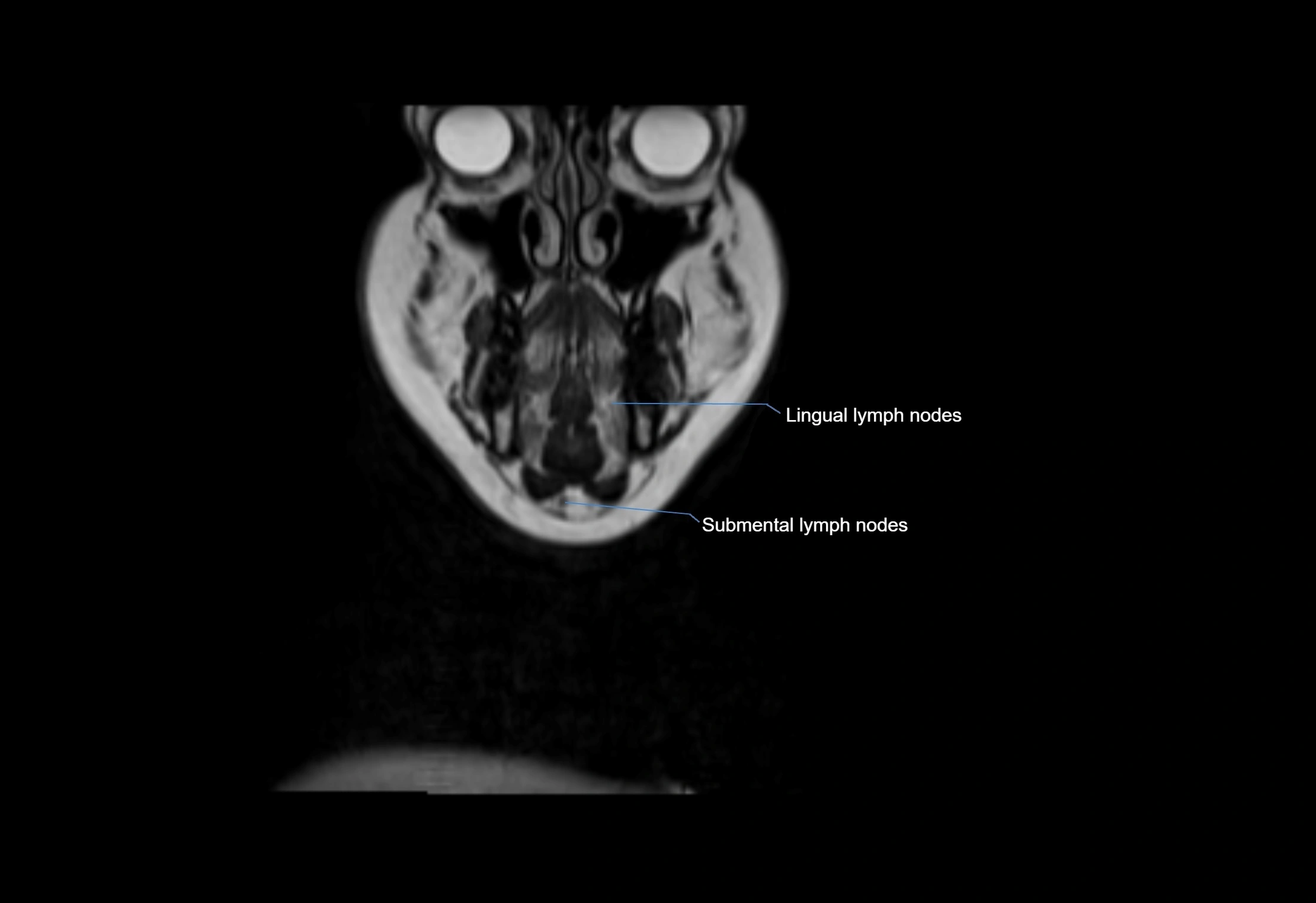 Neck coronal lymph node cross sectional MRI anatomy 3T MRI  image-img-00001-00066.webp